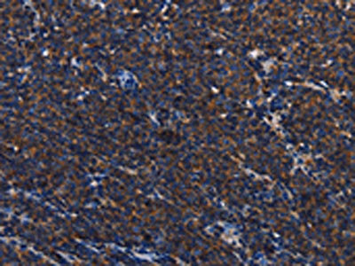 The image on the left is immunohistochemistry of paraffin-embedded Human Lymphoma tissue using CSB-PA480713(PTPRC Antibody) at dilution 1/40, on the right is treated with synthetic peptide. (Original magnification: ×200)