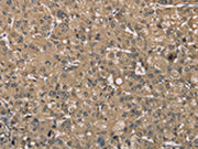 The image on the left is immunohistochemistry of paraffin-embedded Human liver cancer tissue using CSB-PA481049(SASH1 Antibody) at dilution 1/40, on the right is treated with synthetic peptide. (Original magnification: ×200)