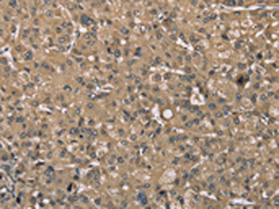 The image on the left is immunohistochemistry of paraffin-embedded Human liver cancer tissue using CSB-PA481049(SASH1 Antibody) at dilution 1/40, on the right is treated with synthetic peptide. (Original magnification: ×200)