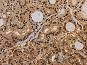 The image on the left is immunohistochemistry of paraffin-embedded Human thyroid cancer tissue using CSB-PA484256(KCNN4 Antibody) at dilution 1/50, on the right is treated with synthetic peptide. (Original magnification: ×200)