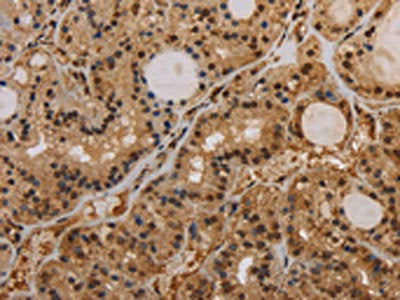 The image on the left is immunohistochemistry of paraffin-embedded Human thyroid cancer tissue using CSB-PA484256(KCNN4 Antibody) at dilution 1/50, on the right is treated with synthetic peptide. (Original magnification: ×200)