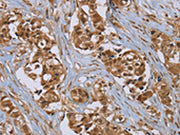 The image on the left is immunohistochemistry of paraffin-embedded Human breast cancer tissue using CSB-PA484448(PUS10 Antibody) at dilution 1/45, on the right is treated with synthetic peptide. (Original magnification: ×200)