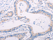 The image on the left is immunohistochemistry of paraffin-embedded Human colon cancer tissue using CSB-PA485300(ADAMTS17 Antibody) at dilution 1/60, on the right is treated with synthetic peptide. (Original magnification: ×200)
