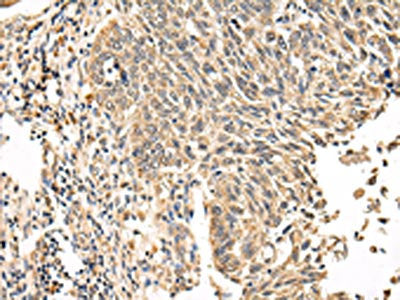The image on the left is immunohistochemistry of paraffin-embedded Human lung cancer tissue using CSB-PA486228(VPS53 Antibody) at dilution 1/20, on the right is treated with fusion protein. (Original magnification: ×200)