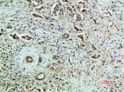 Immunohistochemical analysis of paraffin-embedded human-breast-cancer, antibody was diluted at 1:200