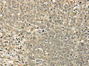 The image on the left is immunohistochemistry of paraffin-embedded Human ovarian cancer tissue using CSB-PA490759(SIAH1 Antibody) at dilution 1/35, on the right is treated with fusion protein. (Original magnification: ×200)