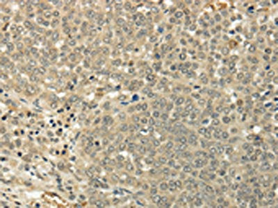 The image on the left is immunohistochemistry of paraffin-embedded Human ovarian cancer tissue using CSB-PA490759(SIAH1 Antibody) at dilution 1/35, on the right is treated with fusion protein. (Original magnification: ×200)