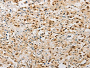 The image on the left is immunohistochemistry of paraffin-embedded Human thyroid cancer tissue using CSB-PA493084(SAE1 Antibody) at dilution 1/20, on the right is treated with fusion protein. (Original magnification: ×200)