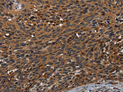 The image on the left is immunohistochemistry of paraffin-embedded Human cervical cancer tissue using CSB-PA494141(PCDHB15 Antibody) at dilution 1/50, on the right is treated with synthetic peptide. (Original magnification: ×200)