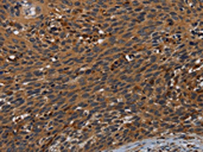 The image on the left is immunohistochemistry of paraffin-embedded Human cervical cancer tissue using CSB-PA494141(PCDHB15 Antibody) at dilution 1/50, on the right is treated with synthetic peptide. (Original magnification: ×200)