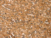 The image on the left is immunohistochemistry of paraffin-embedded Human liver cancer tissue using CSB-PA494754(SNAP29 Antibody) at dilution 1/45, on the right is treated with fusion protein. (Original magnification: ×200)