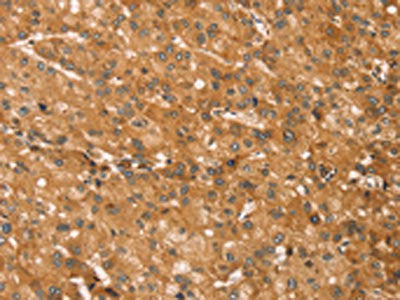 The image on the left is immunohistochemistry of paraffin-embedded Human liver cancer tissue using CSB-PA494754(SNAP29 Antibody) at dilution 1/45, on the right is treated with fusion protein. (Original magnification: ×200)