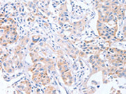 The image on the left is immunohistochemistry of paraffin-embedded Human lung cancer tissue using CSB-PA497239(CDCA4 Antibody) at dilution 1/50, on the right is treated with synthetic peptide. (Original magnification: ×200)