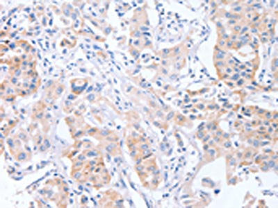 The image on the left is immunohistochemistry of paraffin-embedded Human lung cancer tissue using CSB-PA497239(CDCA4 Antibody) at dilution 1/50, on the right is treated with synthetic peptide. (Original magnification: ×200)