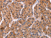 The image on the left is immunohistochemistry of paraffin-embedded Human liver cancer tissue using CSB-PA498240(EFNA5 Antibody) at dilution 1/40, on the right is treated with synthetic peptide. (Original magnification: ×200)