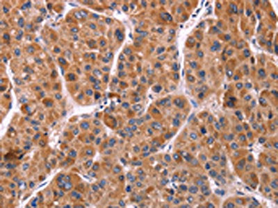 The image on the left is immunohistochemistry of paraffin-embedded Human liver cancer tissue using CSB-PA498240(EFNA5 Antibody) at dilution 1/40, on the right is treated with synthetic peptide. (Original magnification: ×200)