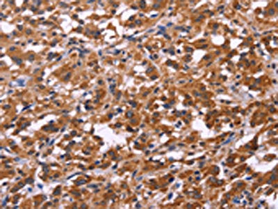 The image on the left is immunohistochemistry of paraffin-embedded Human thyroid cancer tissue using CSB-PA503322(SPATA7 Antibody) at dilution 1/30, on the right is treated with fusion protein. (Original magnification: ×200)