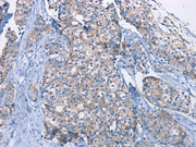 The image on the left is immunohistochemistry of paraffin-embedded Human breast cancer tissue using CSB-PA503789(DMD Antibody) at dilution 1/30, on the right is treated with fusion protein. (Original magnification: ×200)