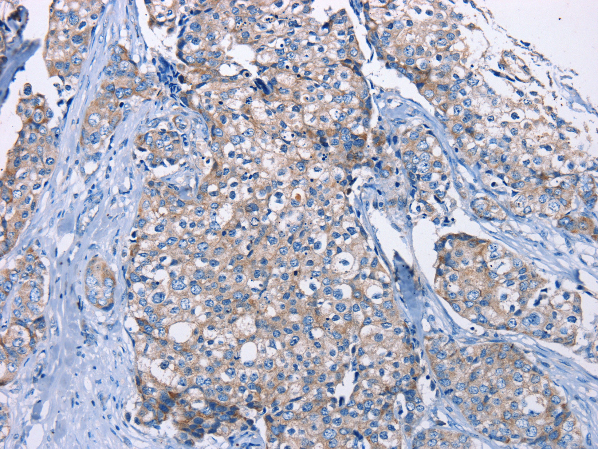 The image on the left is immunohistochemistry of paraffin-embedded Human breast cancer tissue using CSB-PA503789(DMD Antibody) at dilution 1/30, on the right is treated with fusion protein. (Original magnification: ×200)