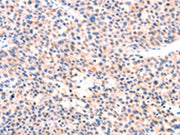 The image on the left is immunohistochemistry of paraffin-embedded Human liver cancer tissue using CSB-PA504012(APBA2 Antibody) at dilution 1/80, on the right is treated with synthetic peptide. (Original magnification: ×200)