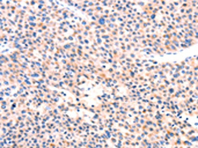 The image on the left is immunohistochemistry of paraffin-embedded Human liver cancer tissue using CSB-PA504012(APBA2 Antibody) at dilution 1/80, on the right is treated with synthetic peptide. (Original magnification: ×200)