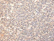 The image on the left is immunohistochemistry of paraffin-embedded Human liver cancer tissue using CSB-PA505479(ZPR1 Antibody) at dilution 1/20, on the right is treated with synthetic peptide. (Original magnification: ×200)