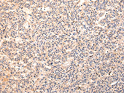 The image on the left is immunohistochemistry of paraffin-embedded Human liver cancer tissue using CSB-PA505479(ZPR1 Antibody) at dilution 1/20, on the right is treated with synthetic peptide. (Original magnification: ×200)