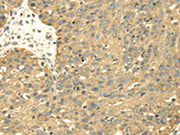 The image on the left is immunohistochemistry of paraffin-embedded Human breast cancer tissue using CSB-PA507142(SRPRB Antibody) at dilution 1/30, on the right is treated with fusion protein. (Original magnification: ×200)