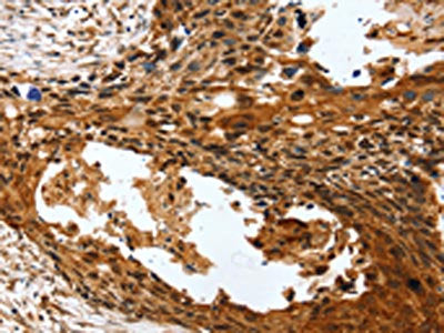 The image on the left is immunohistochemistry of paraffin-embedded Human esophagus cancer tissue using CSB-PA508112(PTX3 Antibody) at dilution 1/40, on the right is treated with synthetic peptide. (Original magnification: ×200)