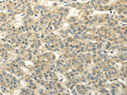 The image on the left is immunohistochemistry of paraffin-embedded Human liver cancer tissue using CSB-PA509583(RASD2 Antibody) at dilution 1/20, on the right is treated with fusion protein. (Original magnification: ×200)