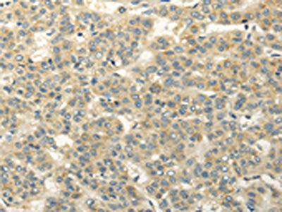 The image on the left is immunohistochemistry of paraffin-embedded Human liver cancer tissue using CSB-PA509583(RASD2 Antibody) at dilution 1/20, on the right is treated with fusion protein. (Original magnification: ×200)