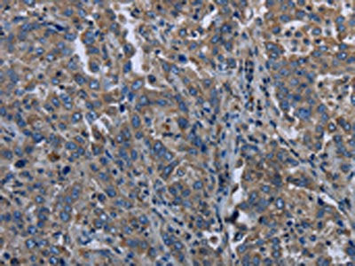 The image on the left is immunohistochemistry of paraffin-embedded Human liver cancer tissue using CSB-PA511767(MAPKAPK2 Antibody) at dilution 1/20, on the right is treated with synthetic peptide. (Original magnification: ×200)