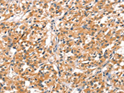 The image on the left is immunohistochemistry of paraffin-embedded Human thyroid cancer tissue using CSB-PA512131(RHOBTB2 Antibody) at dilution 1/30, on the right is treated with synthetic peptide. (Original magnification: ×200)