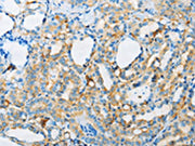 The image on the left is immunohistochemistry of paraffin-embedded Human thyroid cancer tissue using CSB-PA514644(ARSA Antibody) at dilution 1/50, on the right is treated with fusion protein. (Original magnification: ×200)