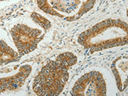 The image on the left is immunohistochemistry of paraffin-embedded Human colon cancer tissue using CSB-PA516472(CCND1 Antibody) at dilution 1/50, on the right is treated with fusion protein. (Original magnification: ×200)