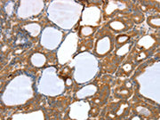 The image on the left is immunohistochemistry of paraffin-embedded Human thyroid cancer tissue using CSB-PA516666(SNX11 Antibody) at dilution 1/30, on the right is treated with fusion protein. (Original magnification: ×200)