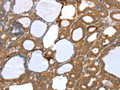 The image on the left is immunohistochemistry of paraffin-embedded Human thyroid cancer tissue using CSB-PA516666(SNX11 Antibody) at dilution 1/30, on the right is treated with fusion protein. (Original magnification: ×200)