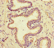 Immunohistochemistry of paraffin-embedded human prostate cancer using CSB-PA518689LA01HU at dilution of 1:100