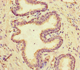 Immunohistochemistry of paraffin-embedded human prostate cancer using CSB-PA518689LA01HU at dilution of 1:100