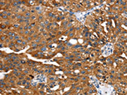 The image on the left is immunohistochemistry of paraffin-embedded Human breast cancer tissue using CSB-PA519093(EGLN1 Antibody) at dilution 1/25, on the right is treated with fusion protein. (Original magnification: ×200)