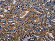 The image on the left is immunohistochemistry of paraffin-embedded Human thyroid cancer tissue using CSB-PA520187(PVRL3 Antibody) at dilution 1/40, on the right is treated with fusion protein. (Original magnification: ×200)