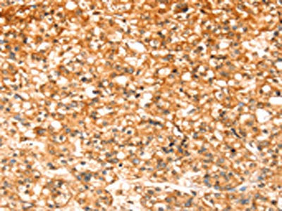 The image on the left is immunohistochemistry of paraffin-embedded Human prostate cancer tissue using CSB-PA520343(SLC32A1 Antibody) at dilution 1/20, on the right is treated with synthetic peptide. (Original magnification: ×200)