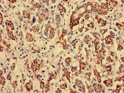 Immunohistochemistry analysis of human breast cancer using CSB-PA520755LA01HU at dilution of 1:100