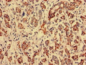 Immunohistochemistry analysis of human breast cancer using CSB-PA520755LA01HU at dilution of 1:100