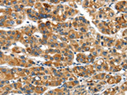The image on the left is immunohistochemistry of paraffin-embedded Human liver cancer tissue using CSB-PA520788(UBAP2 Antibody) at dilution 1/20, on the right is treated with synthetic peptide. (Original magnification: ×200)