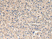 The image on the left is immunohistochemistry of paraffin-embedded Human liver cancer tissue using CSB-PA521183(SLC1A1 Antibody) at dilution 1/30, on the right is treated with synthetic peptide. (Original magnification: ×200)