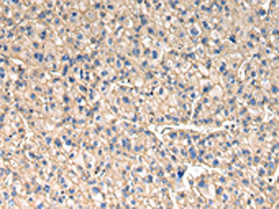 The image on the left is immunohistochemistry of paraffin-embedded Human liver cancer tissue using CSB-PA521183(SLC1A1 Antibody) at dilution 1/30, on the right is treated with synthetic peptide. (Original magnification: ×200)