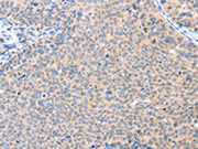 The image on the left is immunohistochemistry of paraffin-embedded Human cervical cancer tissue using CSB-PA521729(AADACL2 Antibody) at dilution 1/25, on the right is treated with fusion protein. (Original magnification: ×200)