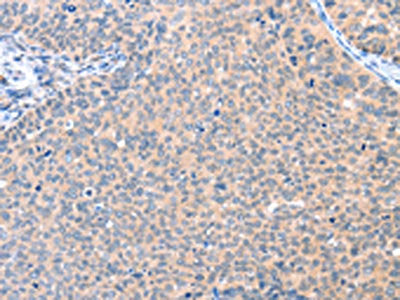 The image on the left is immunohistochemistry of paraffin-embedded Human cervical cancer tissue using CSB-PA521729(AADACL2 Antibody) at dilution 1/25, on the right is treated with fusion protein. (Original magnification: ×200)