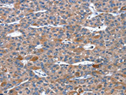 The image on the left is immunohistochemistry of paraffin-embedded Human liver cancer tissue using CSB-PA521847(RGS11 Antibody) at dilution 1/20, on the right is treated with fusion protein. (Original magnification: ×200)